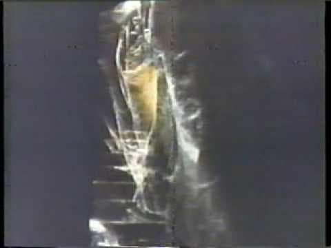 Silent Scream 1980 TV trailer